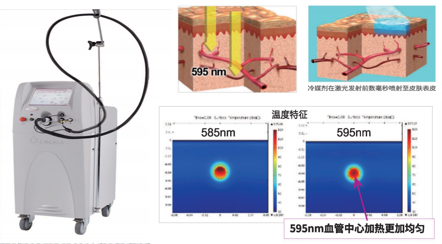 Vbeam595nm脈沖染料激光——鮮紅斑“治”的金標準